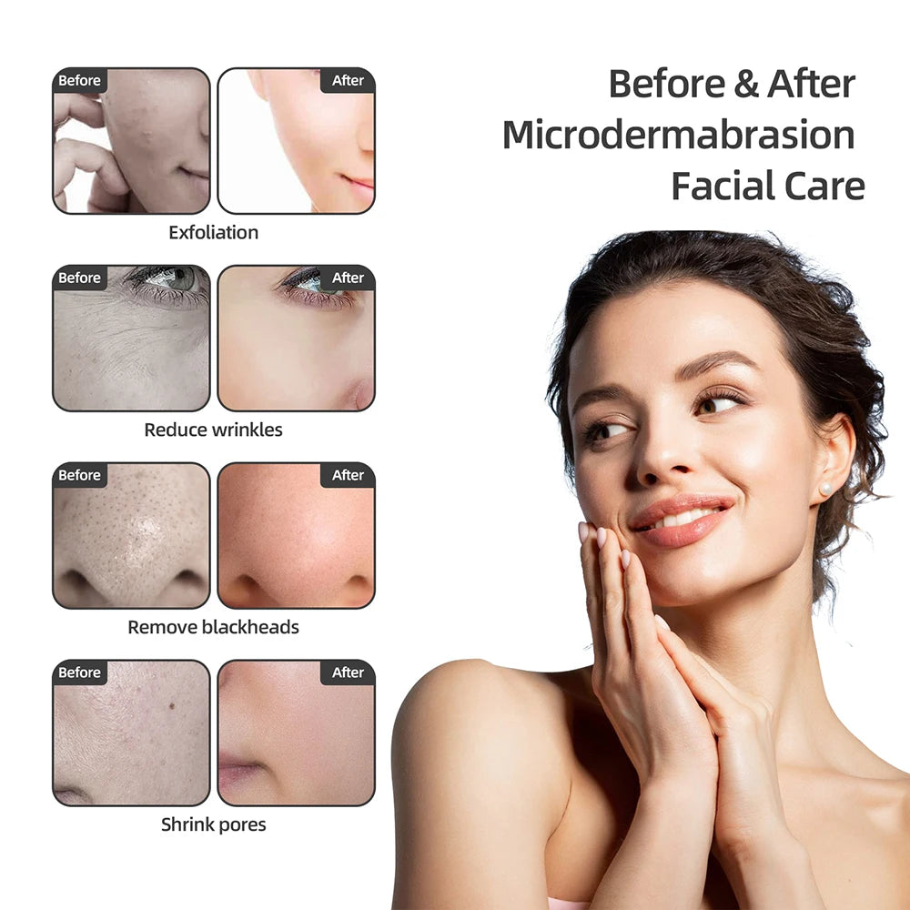 Foreverlily Diamond Microdermabrasion Machine Water Spray
